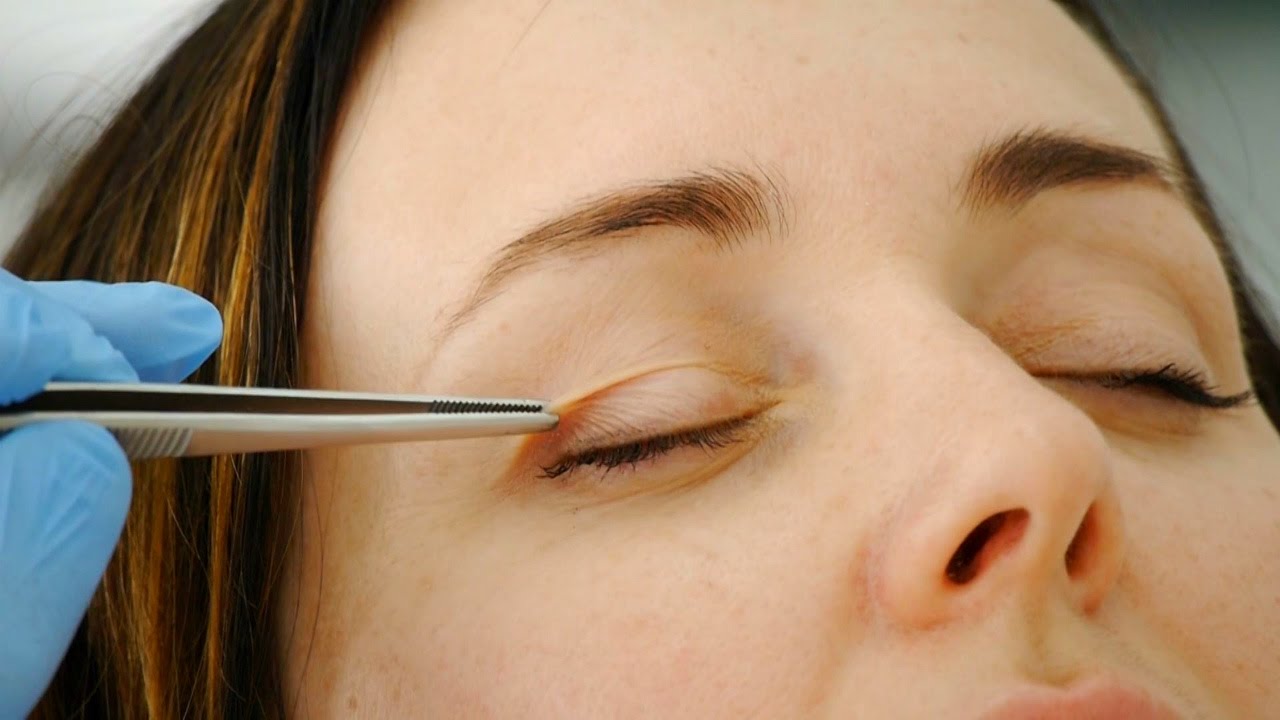 جوانسازی ناحیه اطراف چشم بدون جراحی