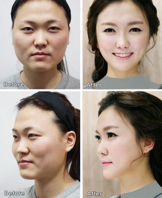 انواع جراحی زیبایی صورت که در کره جنوبی انجام می شود؟