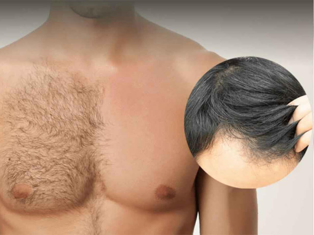 برای کاشت مو به چند گرافت نیاز است؟